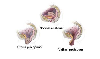 mesane sarkmasi ve uterus prolapsusu
