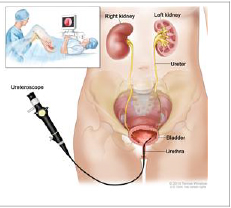 ureterenoskopi