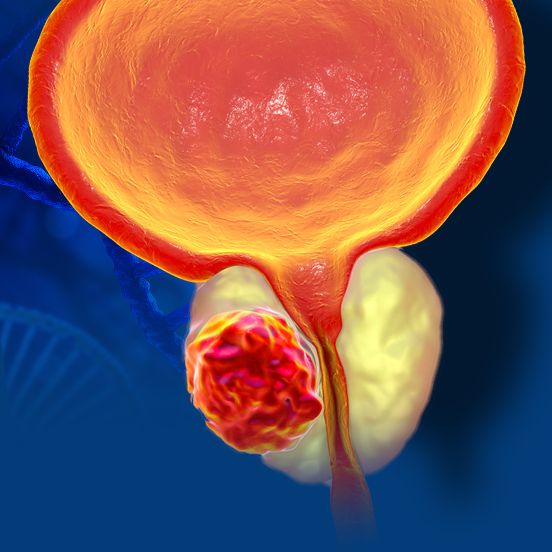 Простата острое. Предстательная железа, Prostata. Простата и предстательная железа. Раковые клетки простаты. Воспаленная железа предстательная железа.